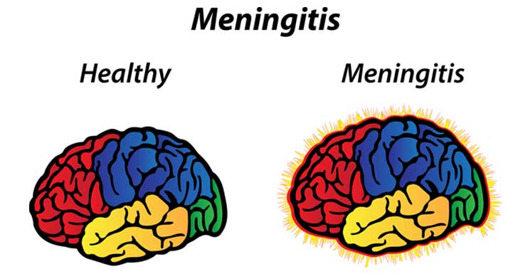 Meningitis Outbreak Kills 269