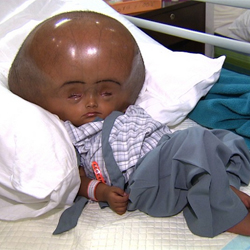 Hydrocephalus Ailment in Children: Deadly but Curable By Oluwaseun Akingboye