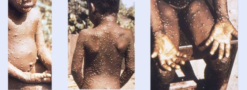 BREAKING: Lagos Records Two Suspected Cases Of Monkey Pox