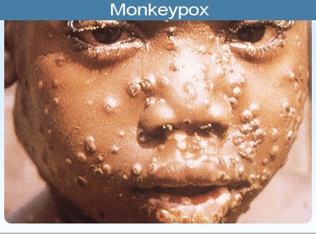 Monkeypox Spreads to Akwa Ibom