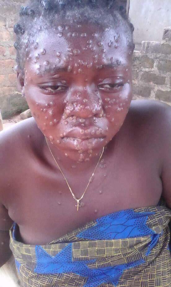 Monkeypox: Another Suspect Moved To BSUTH