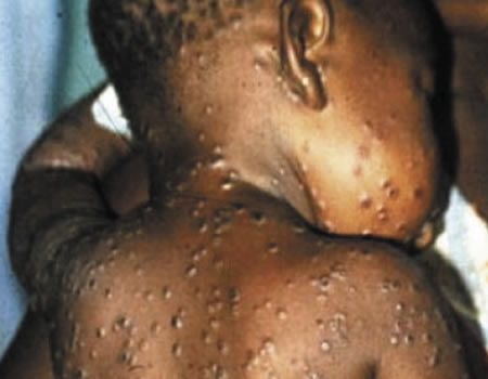 Monkeypox Kills One As Nigeria Records 41 New Cases