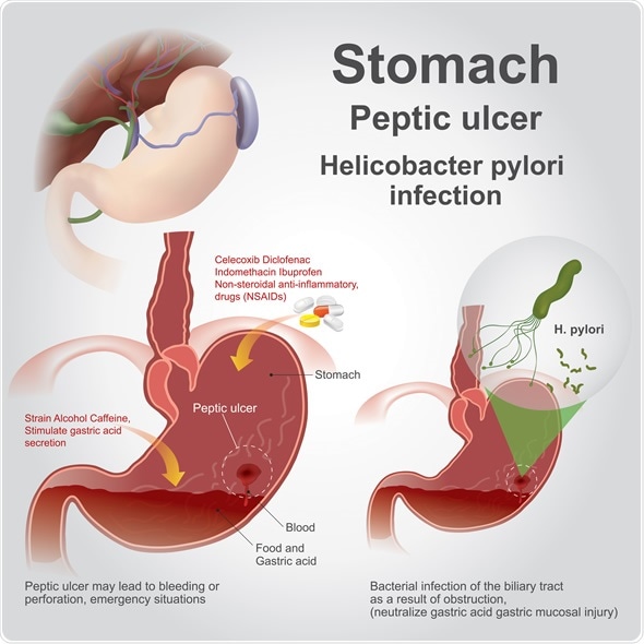 Peptic Ulcer With Francis Ezediuno
