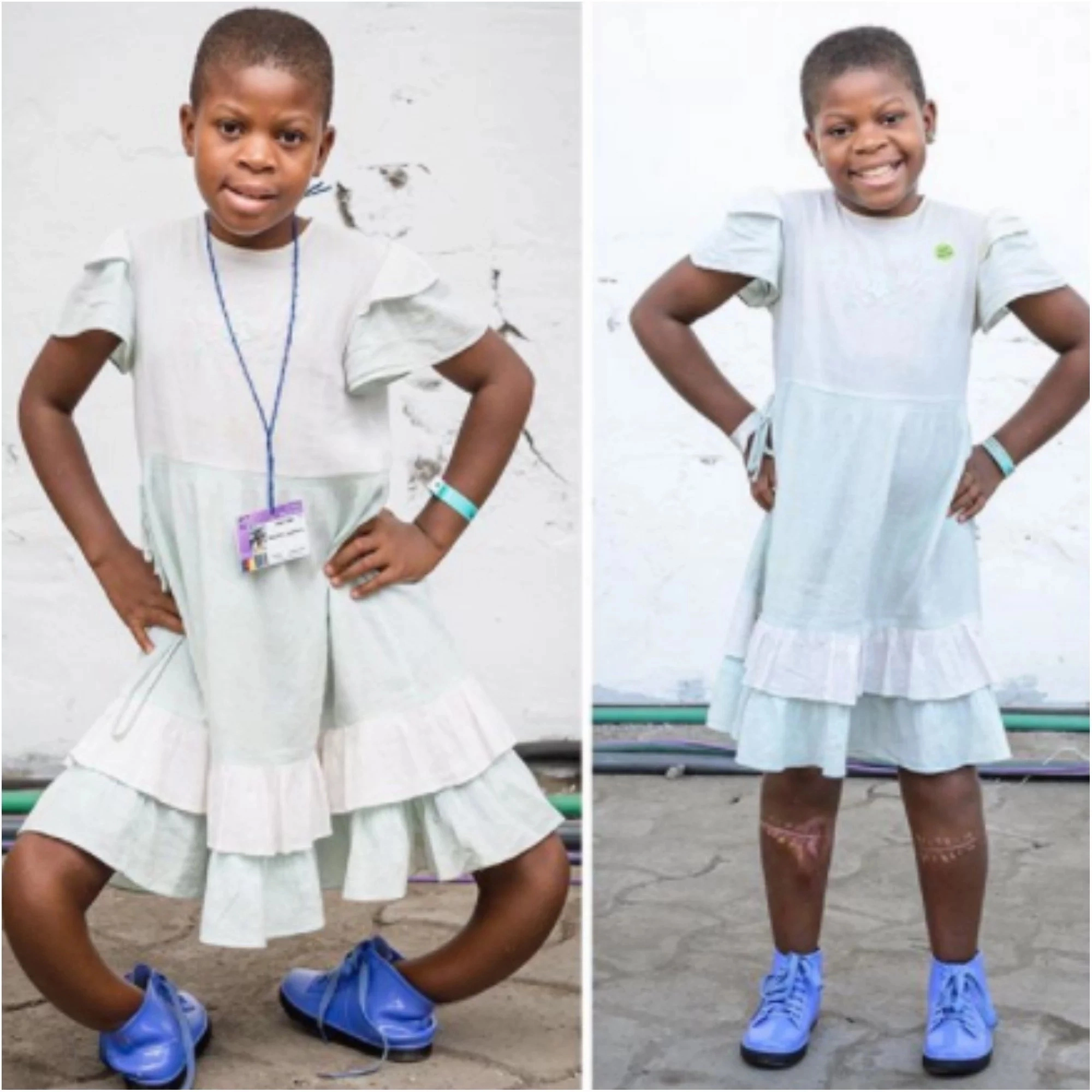 Wow!!! 11 Year Old Girl Successfully Undergoes Surgery To Correct Bow-Legs