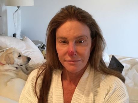 Caitlyn Jenner Might Be Having Serious Skin Issues