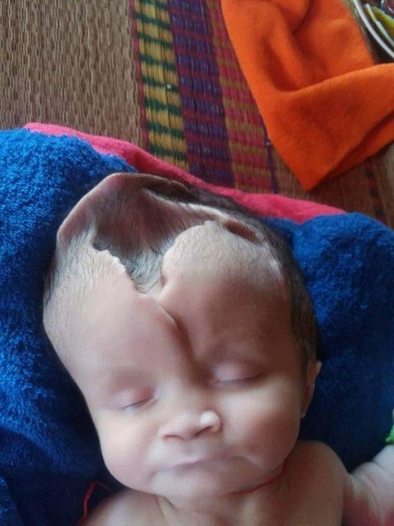 PHOTOS: Baby Born With Part Of Her Skull Jutting Out Of Her Head Survives Against Odds