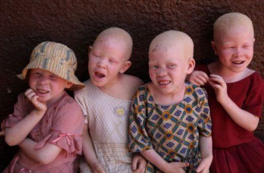 EU Gives Albino Foundation N70 Million