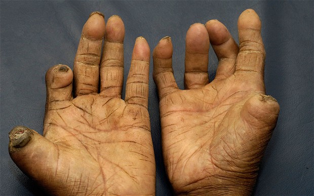 New Risk Gene Variants Responsible For Leprosy Discovered
