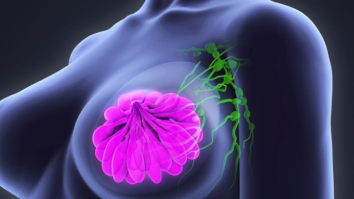 Women With Early Breast Cancer May Avoid Chemotherapy