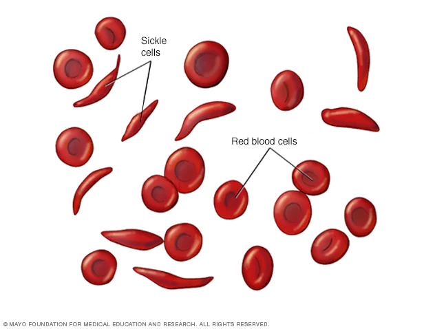 Edo Records Increase In Sickle Cell Cases In 4 Years