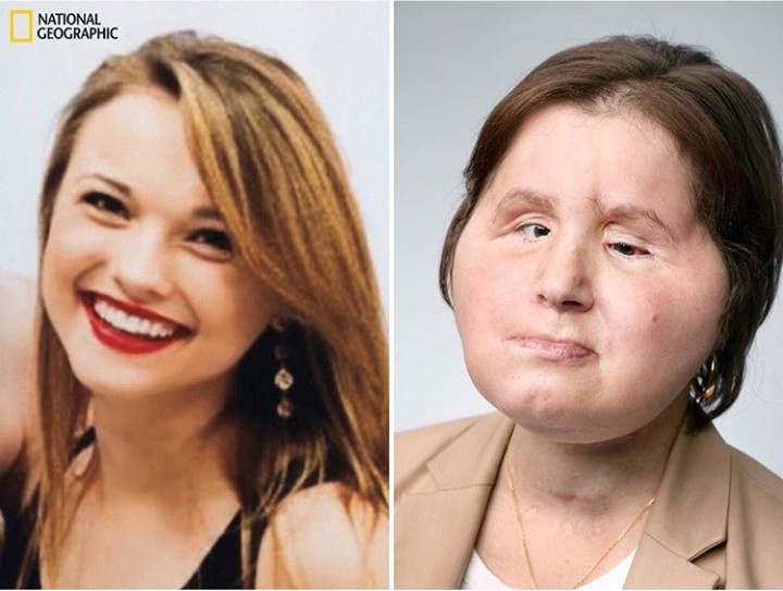 Meet The Youngest Person In The US To Get A Full Face Transplant
