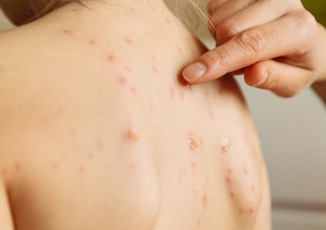Rumour Of Measles Outbreak Dispelled