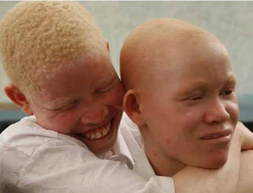 UN Raises Concern Over Continued Albino Attacks