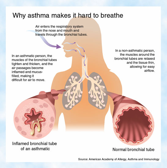 Health Matters: Asthma