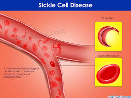 How Lover Abandoned Sickle Cell Patient With Two Kids