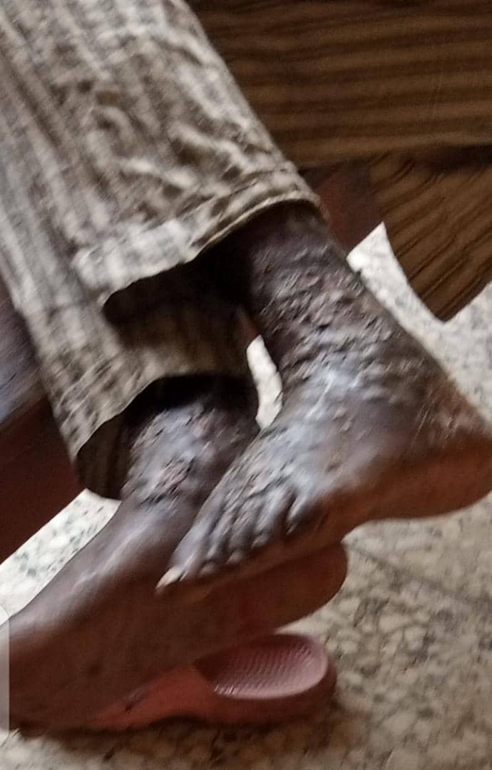 Breaking: Osun Records First Case of Monkeypox -Another Suspected Case In Osogbo