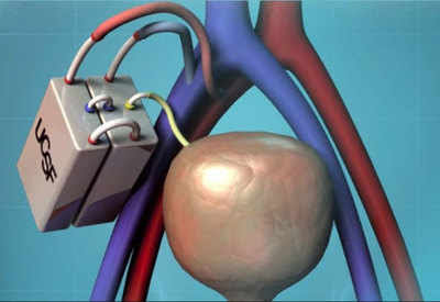 Scientists Develop Artificial Kidney That May End Dialysis