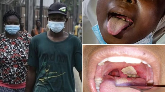 Diphtheria: Osun, 18 Other States May Bring Back Face Mask Use