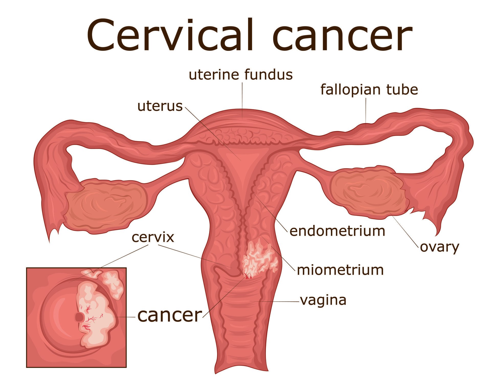 Cervical Cancer: Nigeria Records 12,000 Cases In A Year With 8,000 Deaths
